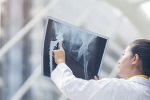 Kanker Tulang Tanpa Amputasi Menurut Dokter